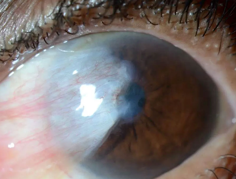 Pterygium growing over the cornea, obscuring vision