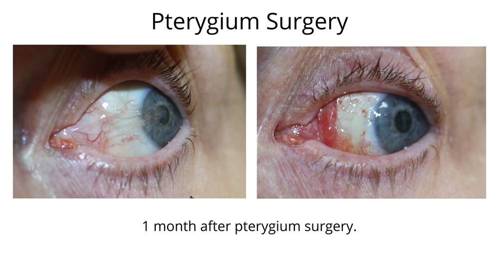 This image shows before and after pterygium surgery performed by Dr Anthony Maloof in Sydney. The first image shows the pterygium covering the iris and impacting on vision. The second image shows the eye 1 month after surgery.