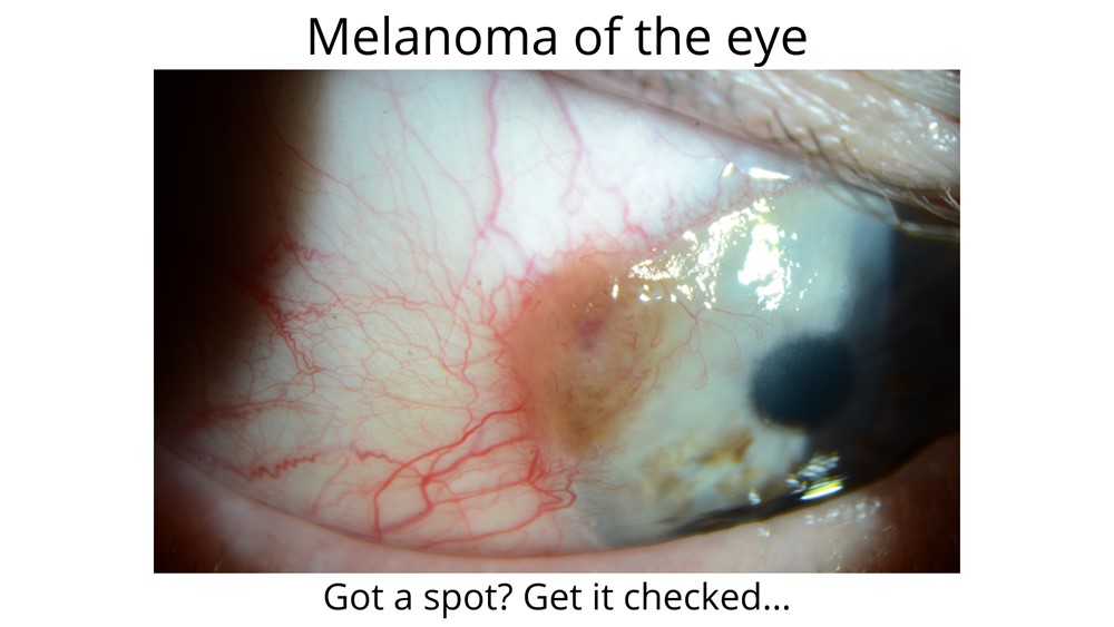 This image shows a melanoma of the eye. This brown spot can sometimes be confused as a pterygium. 