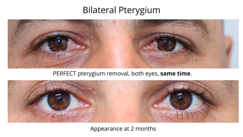 Bilateral Pterygium surgery using the PERFECT technique.
