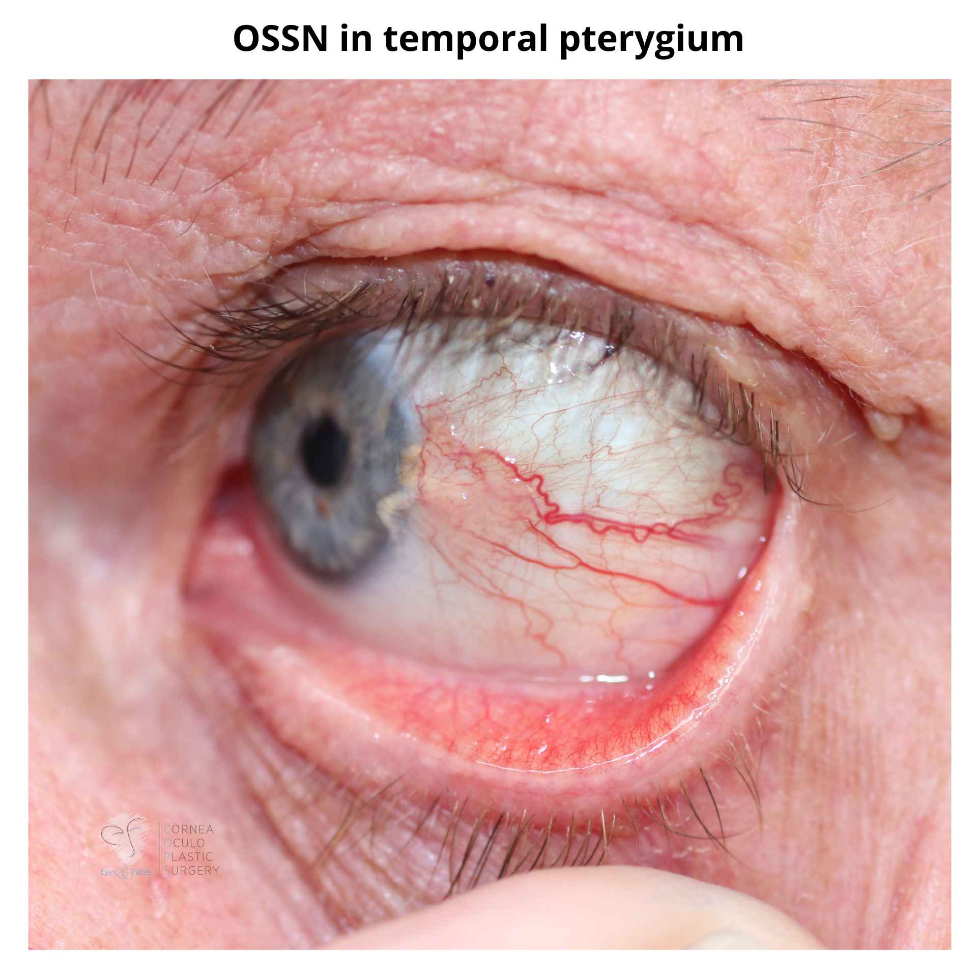 OSSN in temporal pterygium