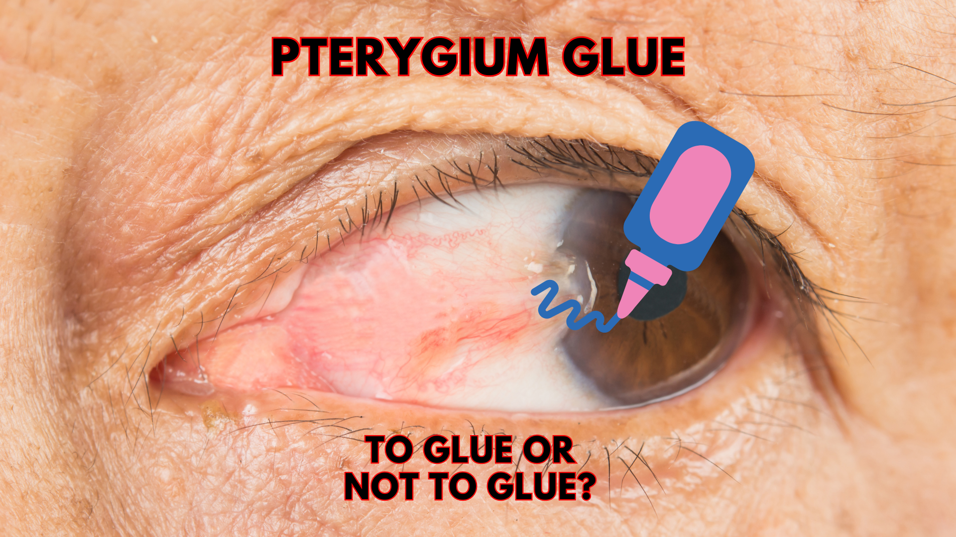 Pterygium glue